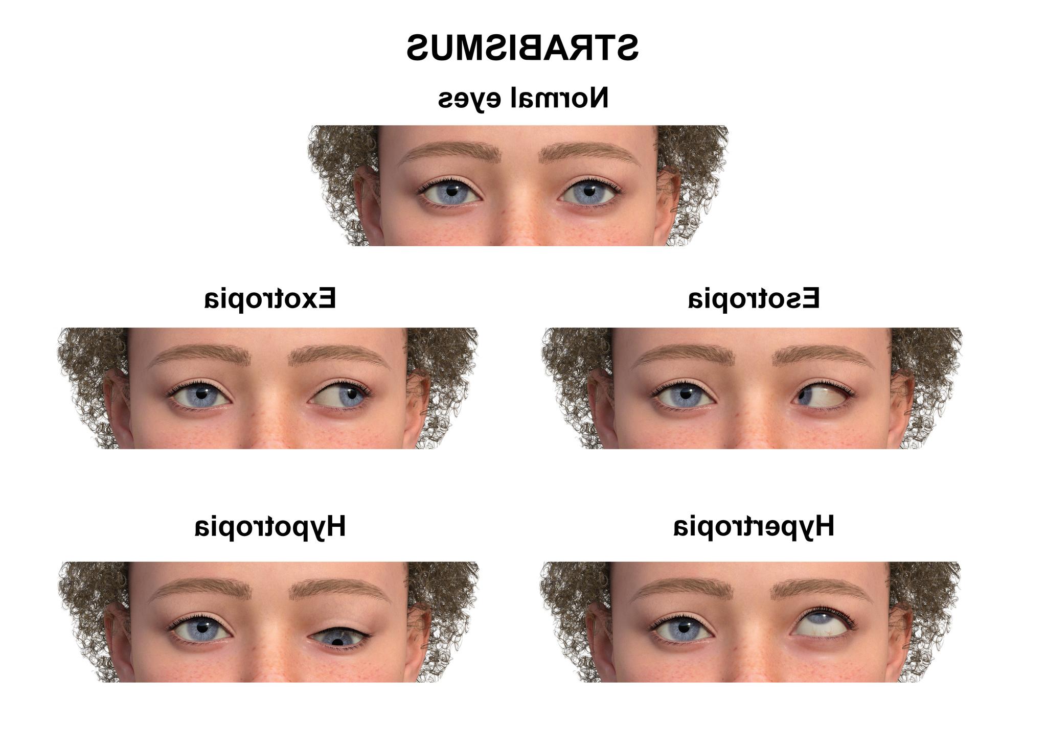 straibusmus types